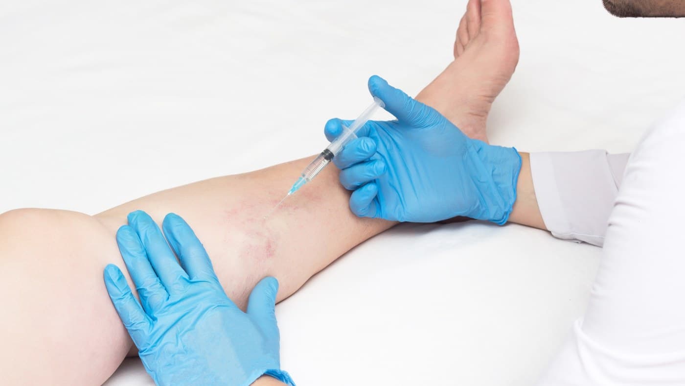 Sclerotherapy being performed on spider veins of the leg at a Bethesda vein clinic